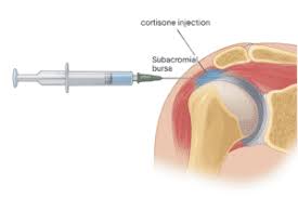 Image result for Subacromial Space Injection