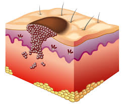 Signs of melanoma can differ in form, color or borders. Non Melanoma Skin Cancer Irish Cancer Society