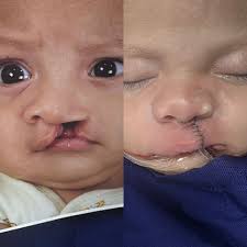 Image result for Cleft Lip