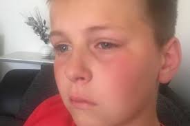 Boy 11 Punched In The Face By Complete Stranger In Unprovoked Attack Mirror Online