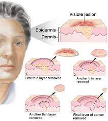 There are 267 doctors for skin cancer in huntington beach. Skin Cancer Treatment Specialist Top Laser Dermatologist Nyc
