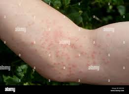 Image result for spinne biss haut reaktion