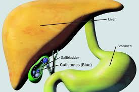 Image result for Gallstone
