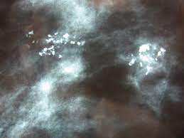 Les huiles essentielles sont des préparations très concentrées et peuvent provoquer des symptômes d'intoxication en cas de surdosage. Microcalcifications