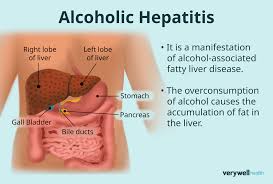 Infographic on alcoholic hepatitis: torso diagram of liver, gallbladder, and digestive organs with explanatory text