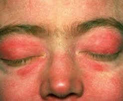 Image result for Dermatomyositis