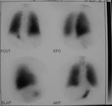 Image result for Ventilation Perfusion Scan