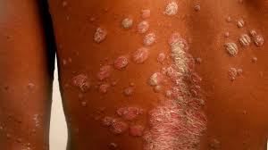 Image result for skin rash acute hiv infection