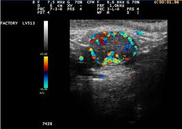 A ultrassonografia com doppler colorido faz o complemento do procedimento tradicional em modo preto e branco, sendo capaz de oferecer informações relevantes quando se faz necessário o uso desta técnica. Diagnostico Precoce De Prenhez Com Ultrassom Doppler Em Vacas Ajuda A Aumentar Producao Portal Embrapa