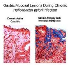 Pada umumnya patogenesis gastritis kronik belum diketahui. Alternatif Penyembuhan Gastritis Kronis Menggunakan Jelly Gamat Gold G Pondok Ilmu