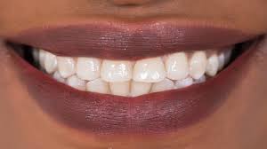 The surface of your teeth is called enamel. Tooth Repair Drug May Replace Fillings Bbc News