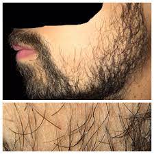 Fill in the comparative or superlative form. Will My Beard Fill In The Photo On The Bottom Shows A Closer Look At The Patchy Area Are The Very Thin White Hairs A Good Indication That I May Grow A