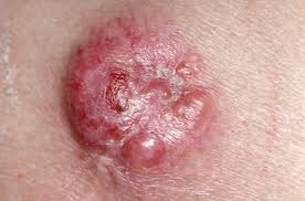 Image result for Dermatofibrosarcoma Protuberans