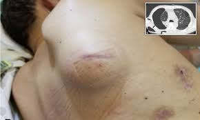 Get the latest facts & statistics about skin cancer, the most common cancer in the united states and worldwide, from experts at the skin cancer foundation. Man 66 Grows A Bubble Under The Skin When Air Escaped From His Cancerous Lung Daily Mail Online
