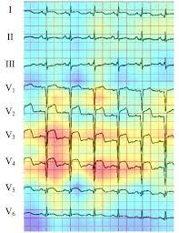 Electrocardiography is the process of producing an electrocardiogram (ecg or ekg). Ki Erkennt Herzinfarkt Im Ekg Zuverlassiger Als Kardiologen