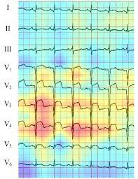 Atiologie, diagnose, therapie / h. Ki Erkennt Herzinfarkt Im Ekg Zuverlassiger Als Kardiologen