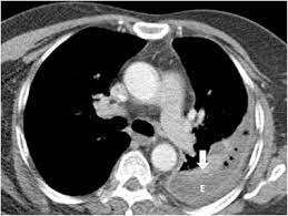 Metintas m, ak g, dundar e, et al. State Of The Art Radiological Investigation Of Pleural Disease Sciencedirect