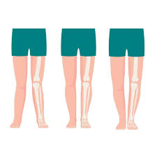 Image result for Out-toeing