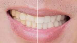 Dental veneers are an excellent way to hide discolored, crooked or damaged teeth, but it's important to consider the pros and cons that come with the territory before getting them. Will Drinking Soft Drinks Through A Straw Prevent Teeth Staining