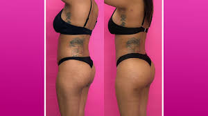 Fat transfers are used in a wide array of different areas. Skin Skinnier Brazilian Butt Lift In San Diego Dr Steve Torres Md