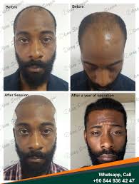 Best Hair Transplant Doctor In Turkey In 2020 Hair Transplant Hair Implants Best Hair Transplant