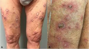 Many clinical variants exist that include atrophic, ulcerative, bullous, annular, linear, inverse, hypertrophic, lichen planopilaris, actinic lp and lp pigmentosus. Programmed Cell Death Protein 1 Inhibitor Induced Granuloma Annulare And Hypertrophic Lichen Planus Masquerading As Squamous Cell Carcinoma Jaad Case Reports