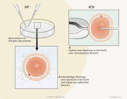 Behandlung Ivf Icsi Behandlung Bei Unerfulltem Kinderwunsch