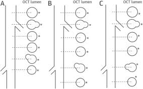 Maybe you would like to learn more about one of these? Impact Of Side Branch Modeling On Computation Of Endothelial Shear Stress In Coronary Artery Disease Coronary Tree Reconstruction By Fusion Of 3d Angiography And Oct Sciencedirect