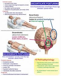 Image result for Decorticate Posturing