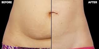 The coolsculpting abdomen fat reduction procedure is specifically designed for those who are within 5 to 35 pounds of their ideal/target weight and are frustrated with stubborn fat. Coolsculpting Permanent Fat Removal Philadelphia Pa