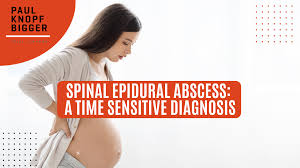 Image result for Spinal Epidural Abscess