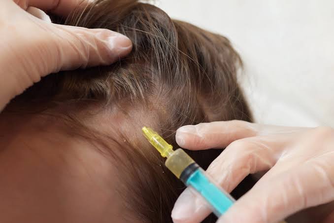Root Hair Institute is the go-to for Growth Factor Hair Restoration in  Seattle