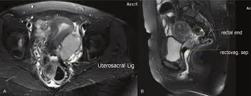 Endometriosis is a full body condition in which cells similar to those in the endometrium, the layer of tissue that normally covers the inside of the uterus, grow outside the uterus. Magnetic Resonance Imaging Mri Characteristics Of Deep Infiltrative Download Scientific Diagram