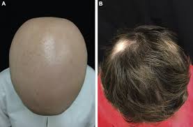 Successful treatment for alopecia areata. Ruxolitinib For The Treatment Of Severe Alopecia Areata Journal Of The American Academy Of Dermatology