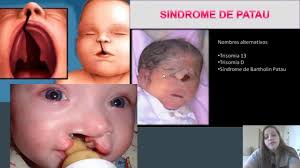 La sindrome di edwards è, dopo la sindrome di down la più comune trisomia di tipo autosomico. Sindrome De Patau Youtube
