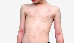 Hasil gambar untuk rubella pada anak