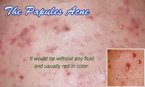 Acne breakouts range from mild or moderate to severe. Inflammatory Or Comedonal Acne Its Papules Pustules Type