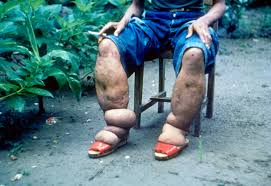 Pdf ), text file (.txt) or read online. Lymphatic Filariasis Wikipedia