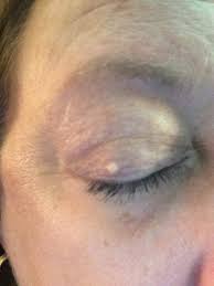 Image result for milium cyst on eyelid