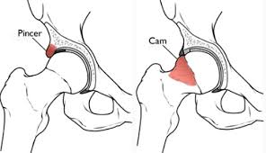 Image result for Hip Labral Tear