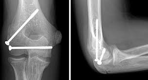Image result for Lateral Condyle Fracture