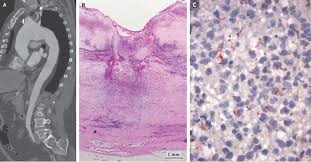 Image result for Cardiovascular Syphilis