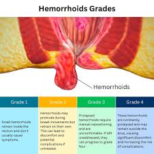 Image result for Hemorrhoid