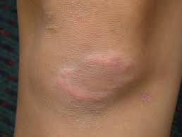 Rheumatic fever nodules are typically associated with acute rheumatic fever in children. Granuloma Annulare Images Dermnet Nz