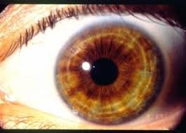 Iridology Nerve Rings Iridology Natural Remedies Health Health