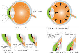 Glaucoma is one of the leading causes of blindness for people over the age of 60. Types Of Glaucoma
