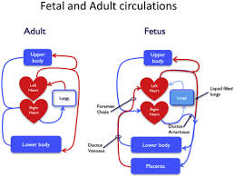 Image result for Delayed Transition from Fetal Circulation