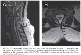 Image result for Spinal Epidural Abscess