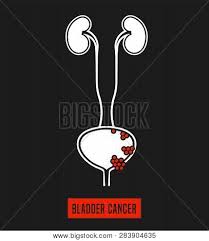 0.5, 1.0) or among men (or=0.7, 95% ci: Bladder Cancer Vector Photo Free Trial Bigstock