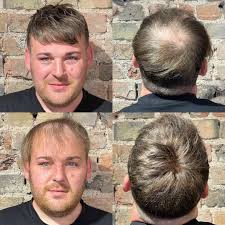 Since a guy's hair loss proceeds to his 30s, and even beyond, a person who receives a hair transplant in his 20s will probably require additional remedies suggest taking hair transplant in early age. Neu Hair 4 Men Uk Meet Lewis 30yrs Old Since His Early 20 S Lewis Has Struggled With Thinning Hair And A Receding Hairline And Just Wanted Hair Again Lewis Would Try